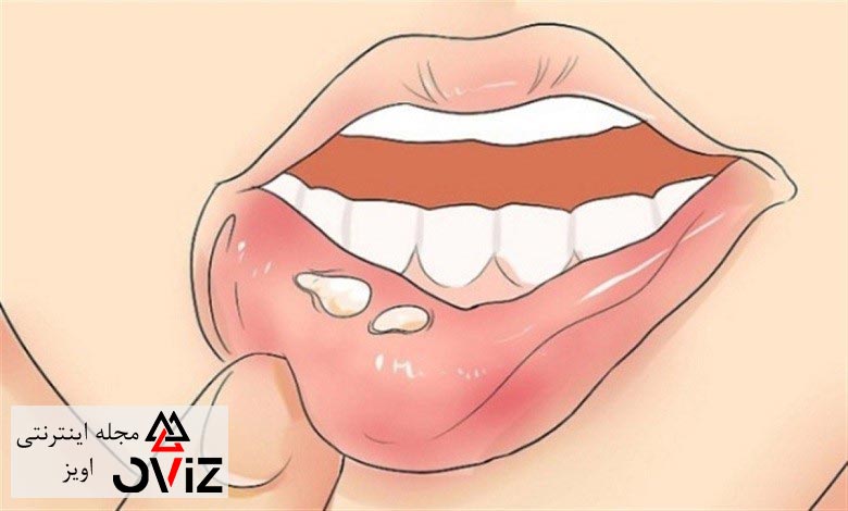 درمان آفت دهان در خانه