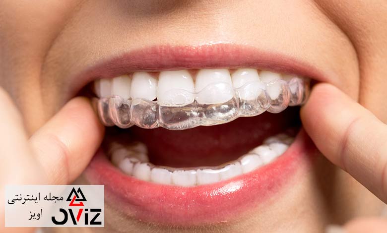 راه‌های پیشگیری کردن از لق شدن دندان در ارتودنسی