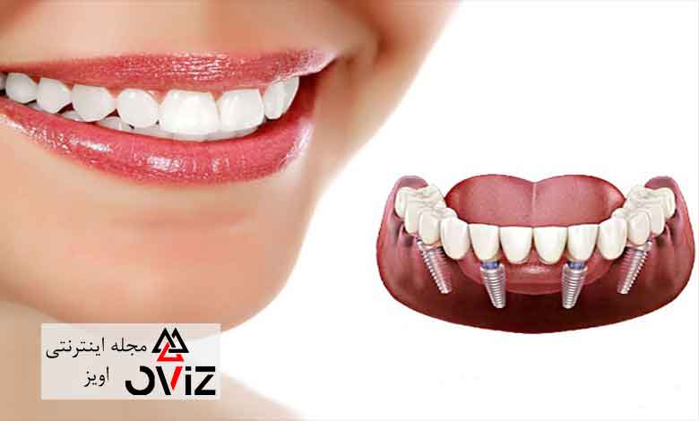 مزایای ایمپلنت دندان در ترکیه