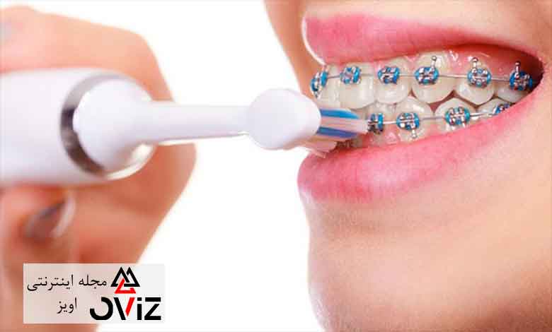 بهترین خمیر دندان ارتودنسی چه ویژگی هایی دارد؟