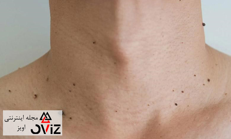 بهترین روش های برداشتن خال گوشتی در خانه | مجله اویز