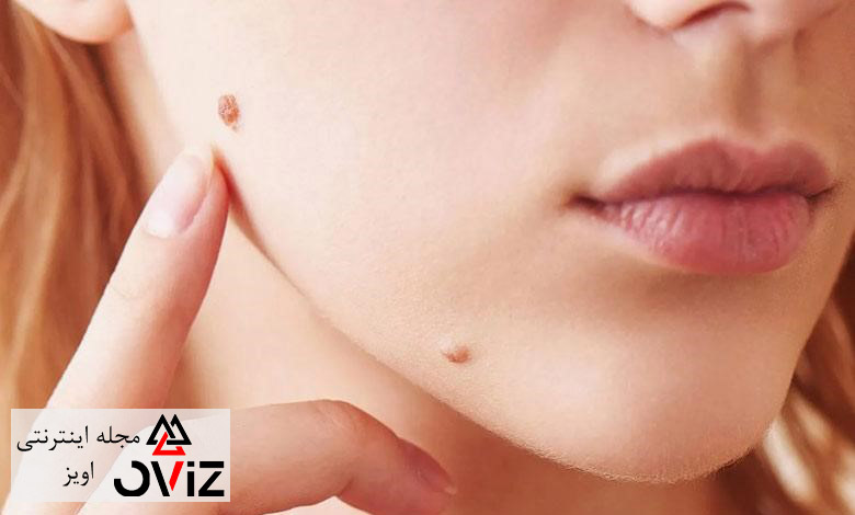 بهترین روش های برداشتن خال گوشتی در خانه | مجله اویز